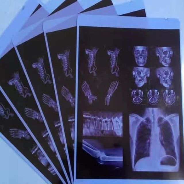 德士威蓝基激光医用胶片X光，CT,CR,DR