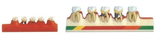 牙周病分类模型